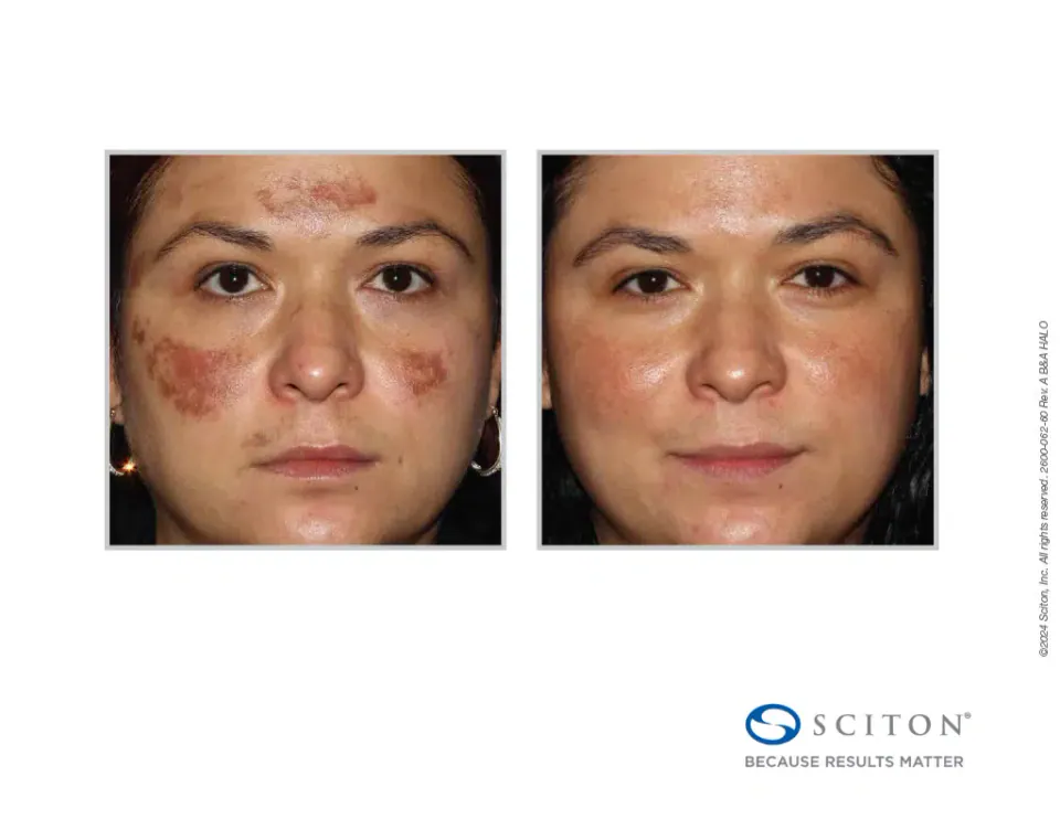 Pigmentation across the forehead and cheeks before and after Halo treatment