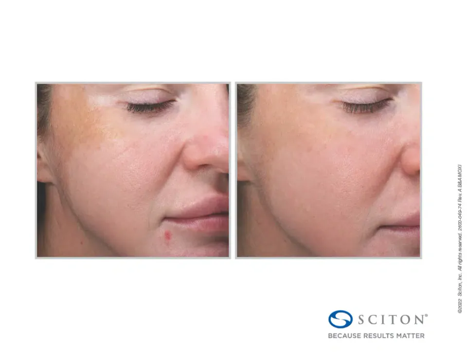 Pigmentation and redness on the cheek before and after Moxi treatment