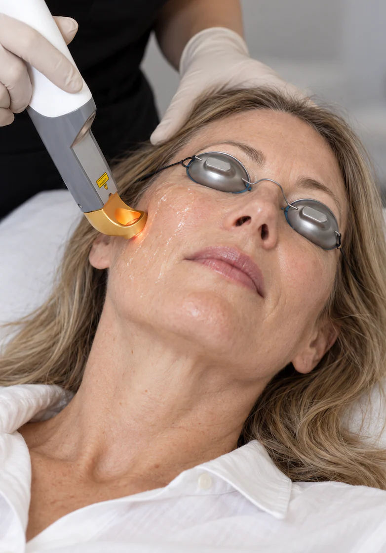 A practitioner treating a patient's cheek with the Excel V+ handpiece, eyes shielded with laser goggles