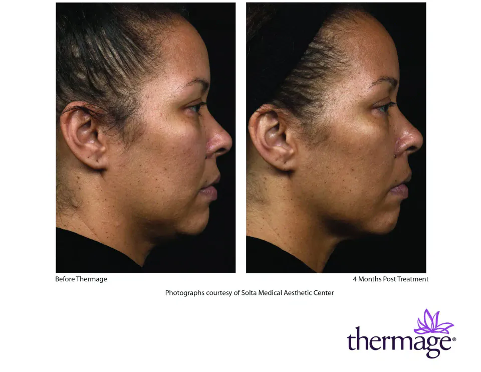 Profile before Thermage and 4 months post treatment