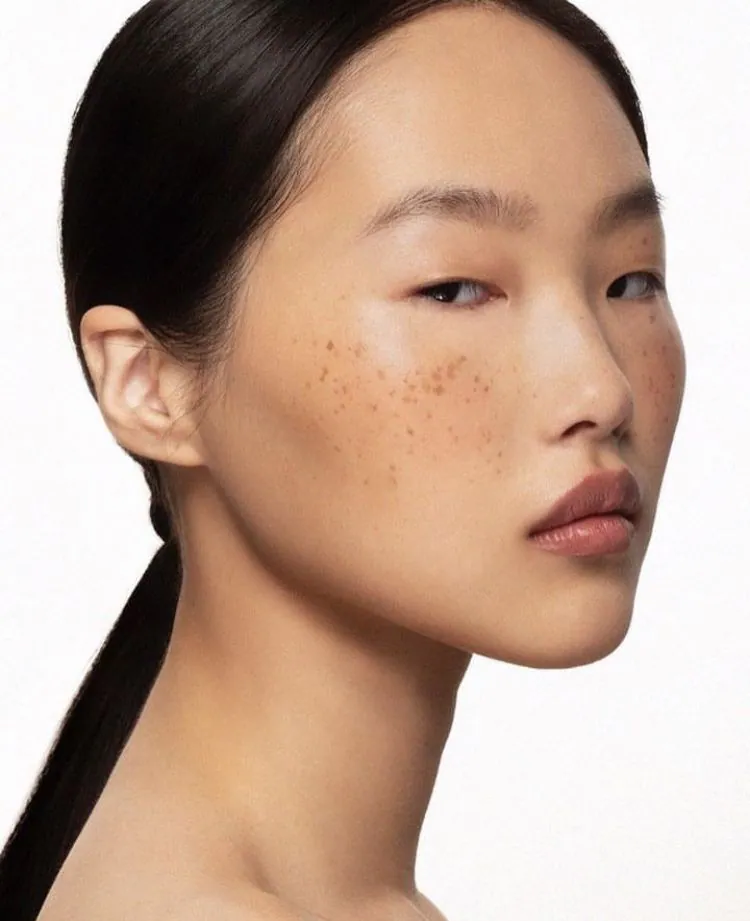 Profile portrait showing freckles and pigmentation