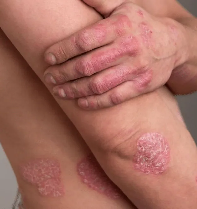 Raised red psoriasis plaques with silvery scale on the knees and hands