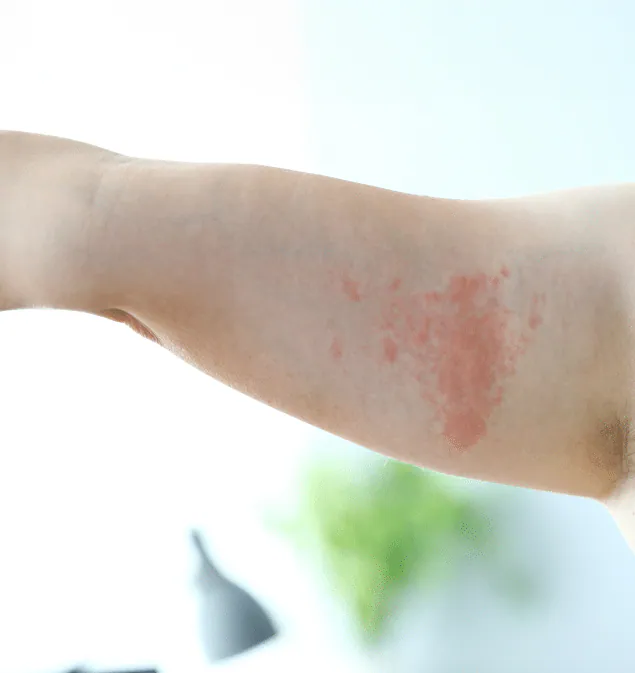 Raised red welts of hives on the inner arm