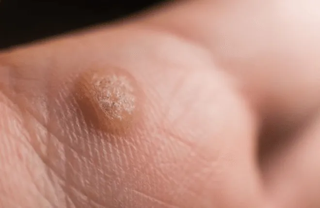 A raised wart on the skin of the hand