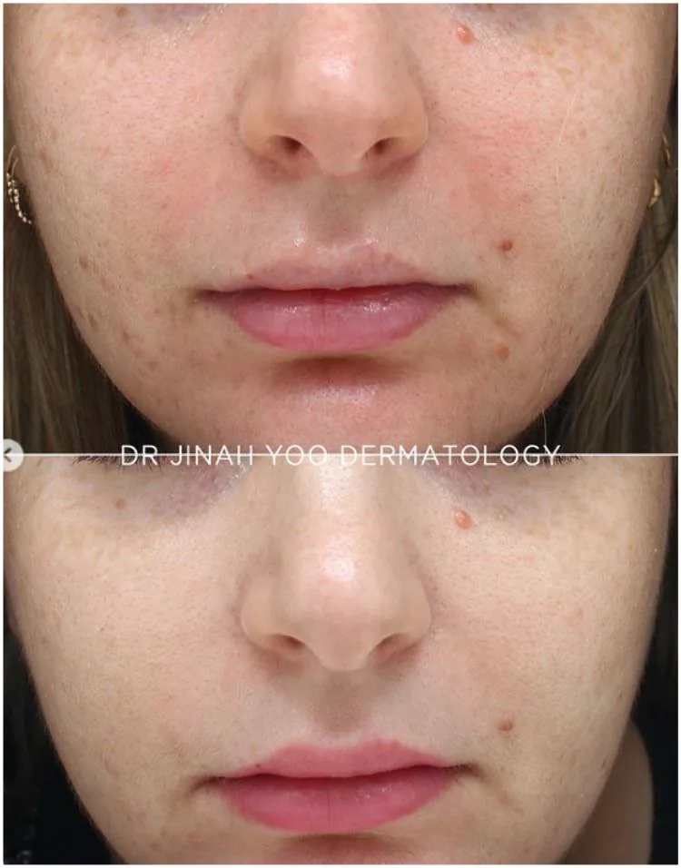 Rosacea before and after treatment at Dr Jinah Yoo Dermatology