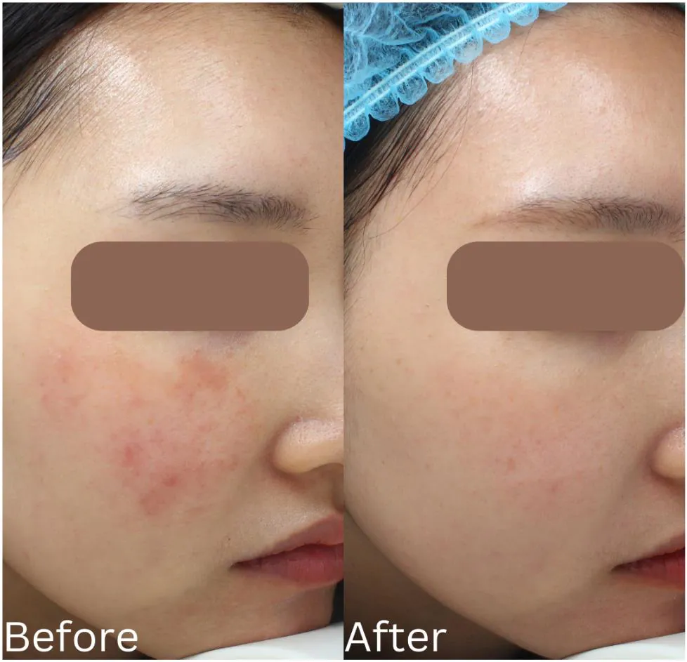 Rosacea before and after treatment at Dr Jinah Yoo Dermatology