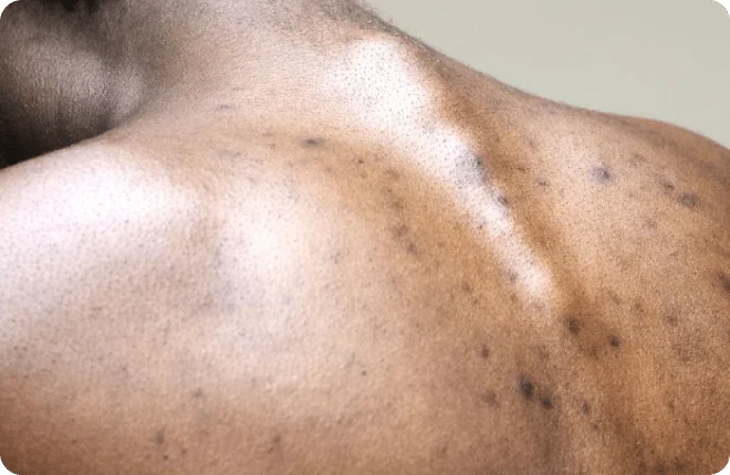 Shoulder and upper back of a person with darker skin showing scattered dark marks
