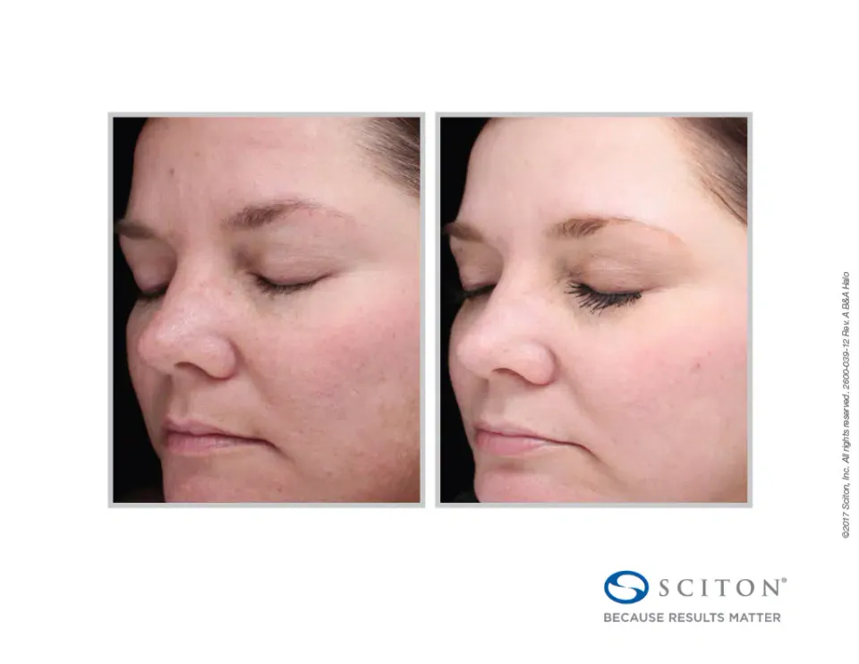 Skin tone and texture on the face before and after Halo treatment