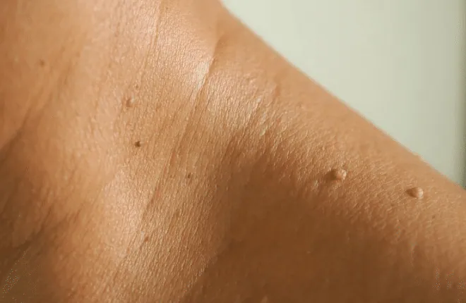 Small skin tags on the skin of the shoulder