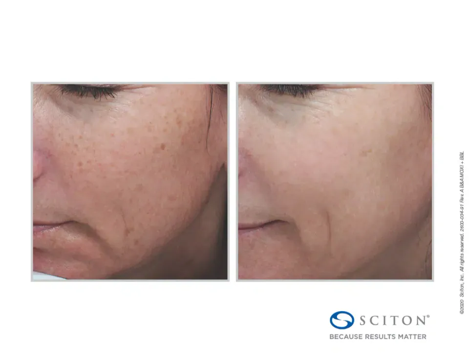 Sun spots and uneven tone on the cheek before and after Moxi treatment