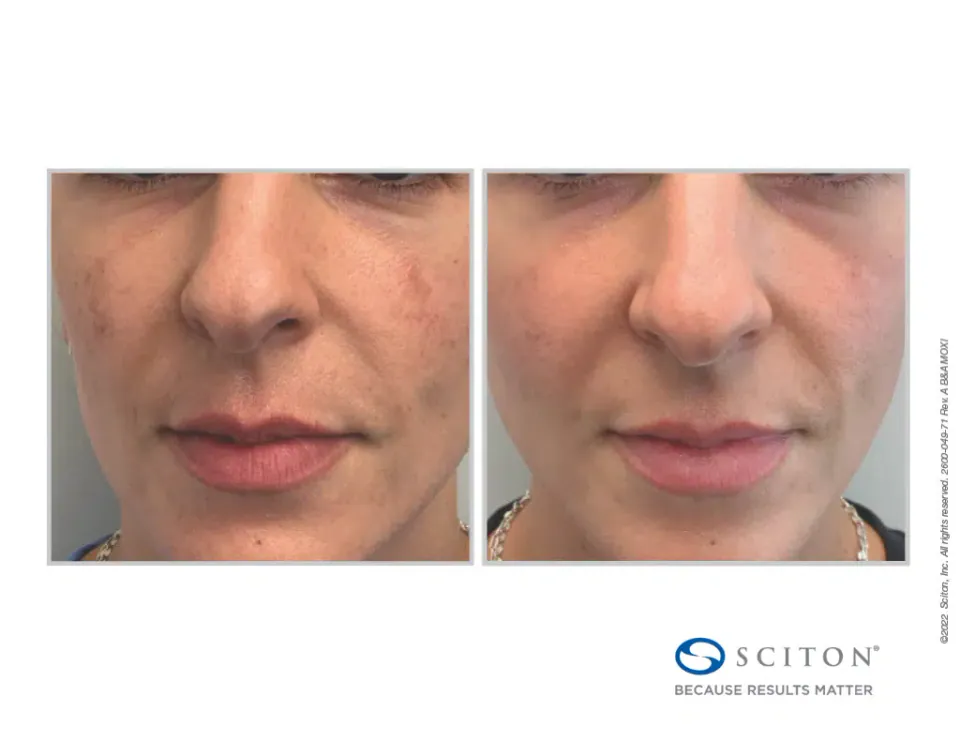 Tone and texture on the lower face before and after Moxi treatment