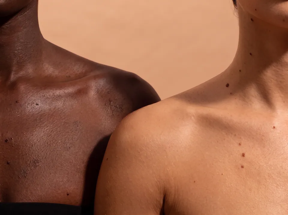 Two shoulders and necks side by side, showing moles and skin texture across different skin tones