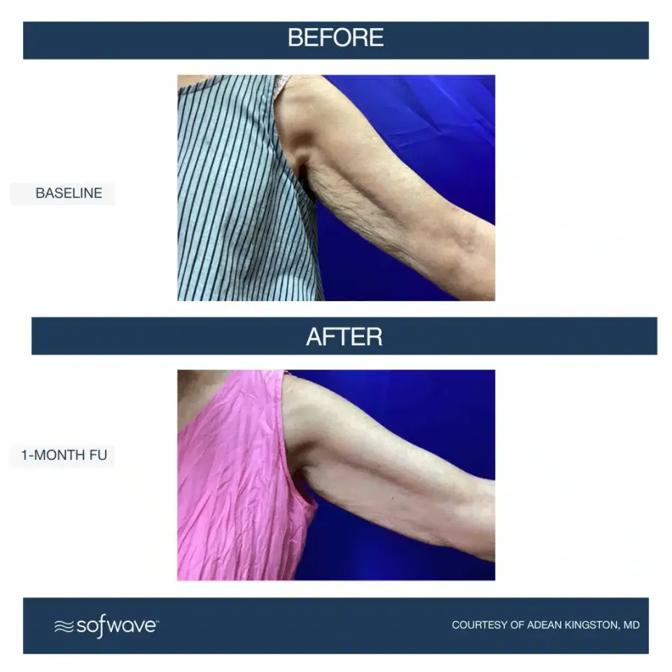 Upper arm at baseline and at 1-month follow-up, Sofwave
