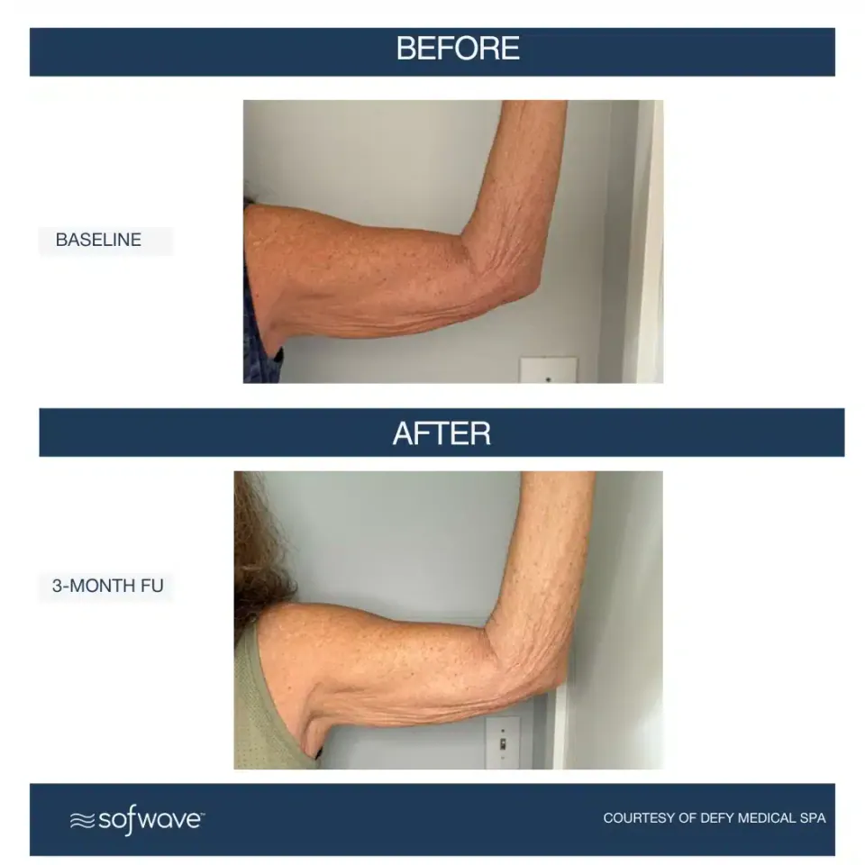 Upper arm at baseline and at 3-month follow-up, Sofwave