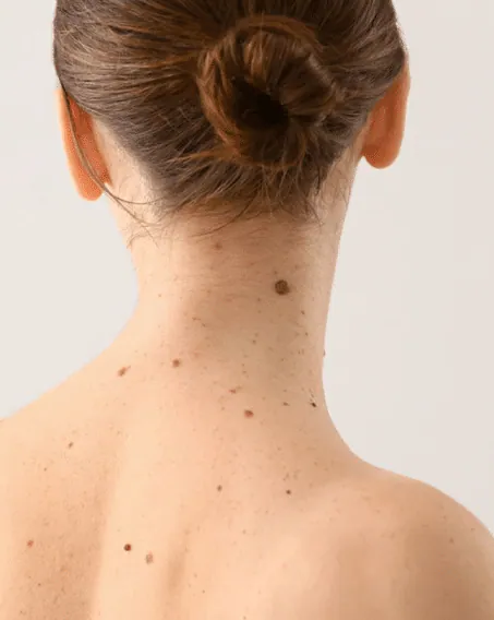 A woman with her hair in a bun, showing scattered moles on her neck and upper back