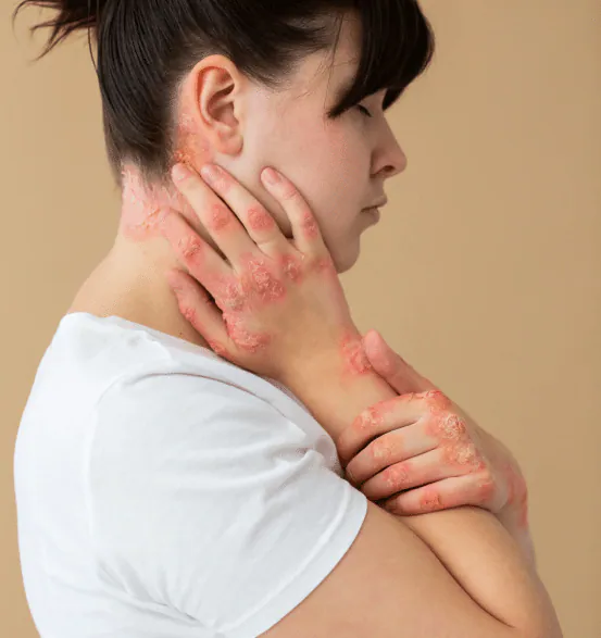 A woman with red, scaly psoriasis patches on her neck, hands and arms