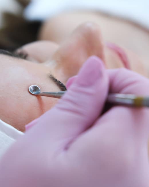 Acne Extraction, Dr Jinah Yoo