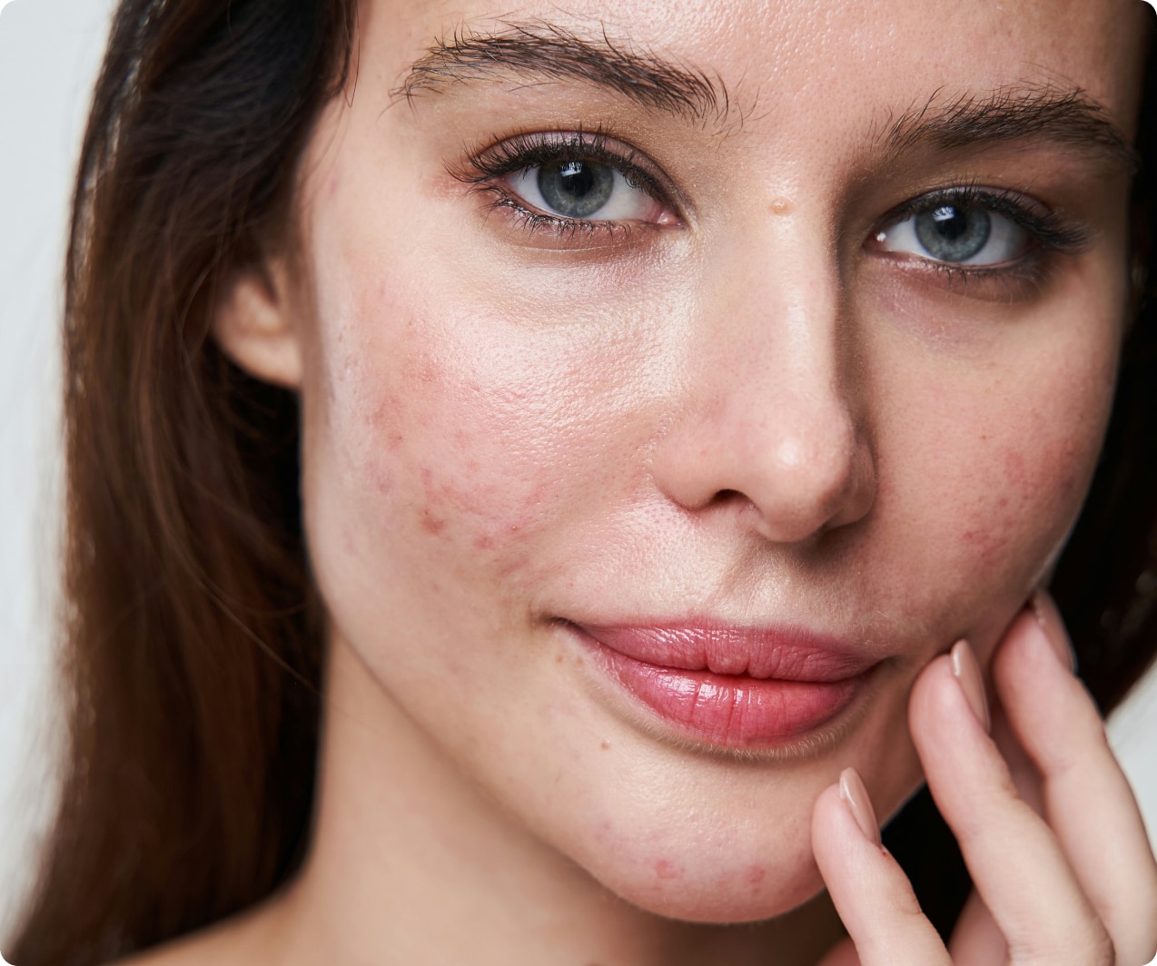 Acne, Dr Jinah Yoo