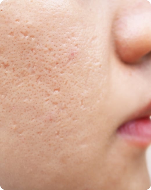 Acne Scars, Dr Jinah Yoo