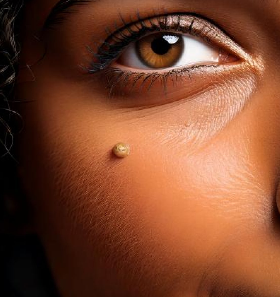 Close Up Wart on Face, Dr Jinah Yoo