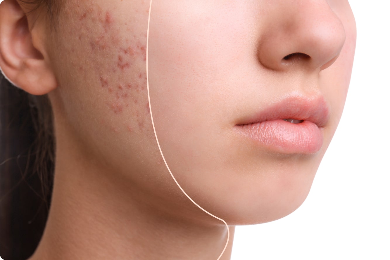 Dr Jinah Yoo Acne Facial 11