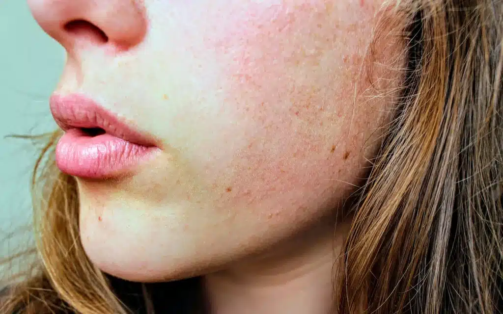 close up of a woman showing what is papulopustular rosacea