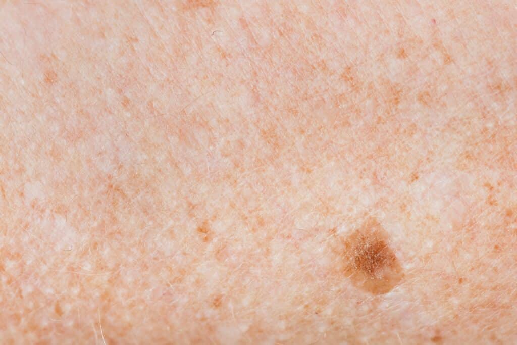 Pigmentation, Dr Jinah Yoo