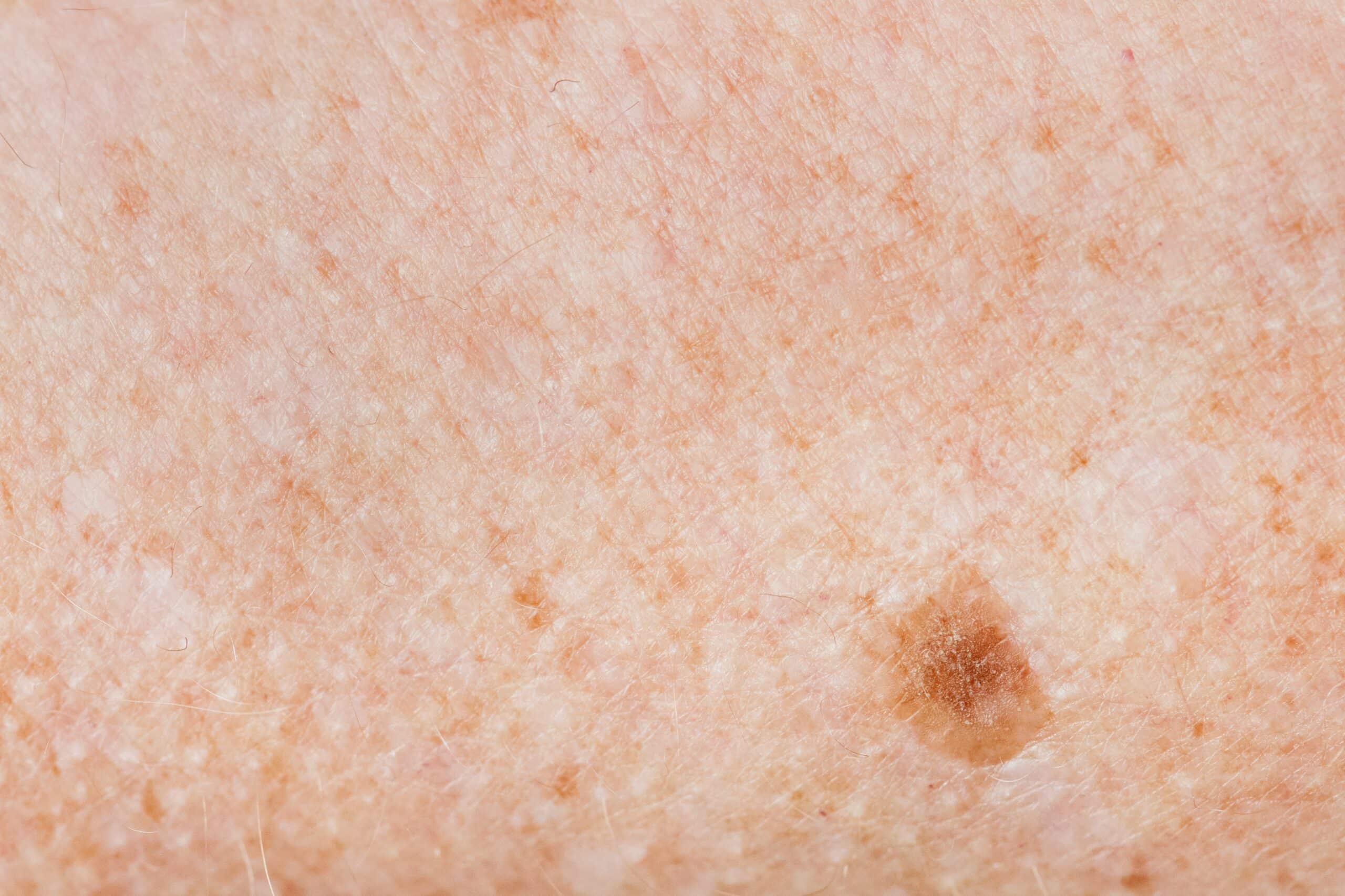 Pigmentation, Dr Jinah Yoo