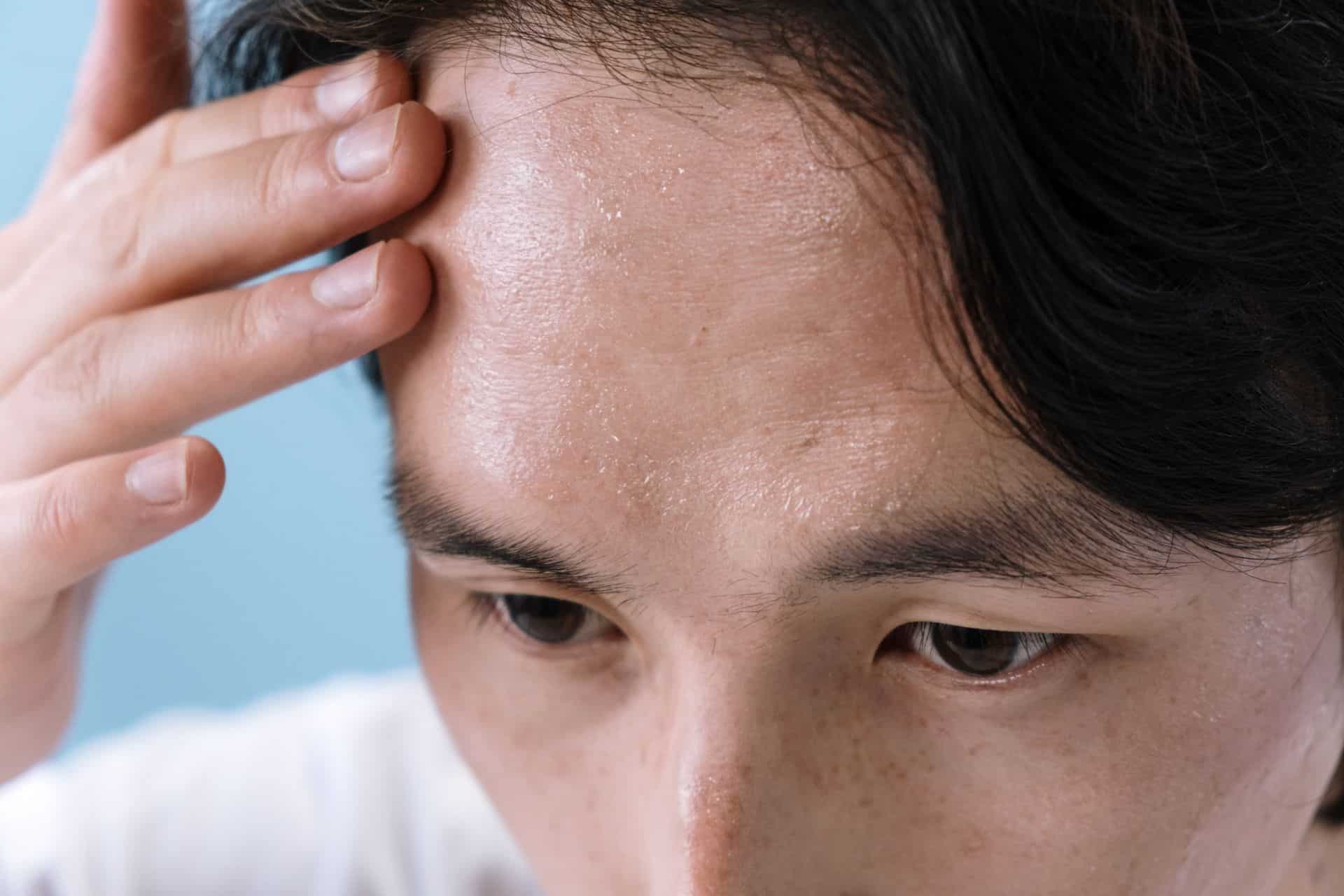 Man with visible sweat on his forehead, a common sign of hyperhidrosis